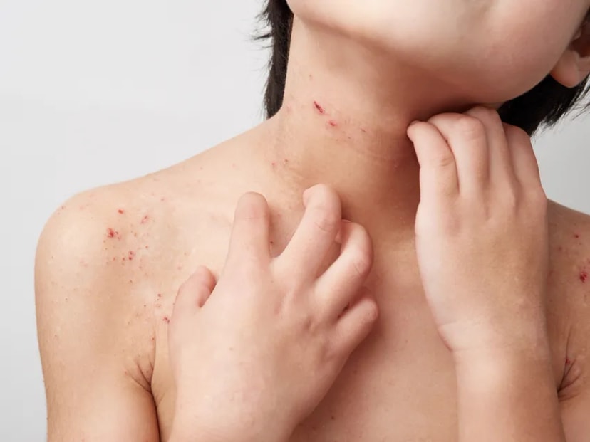 Impetigo