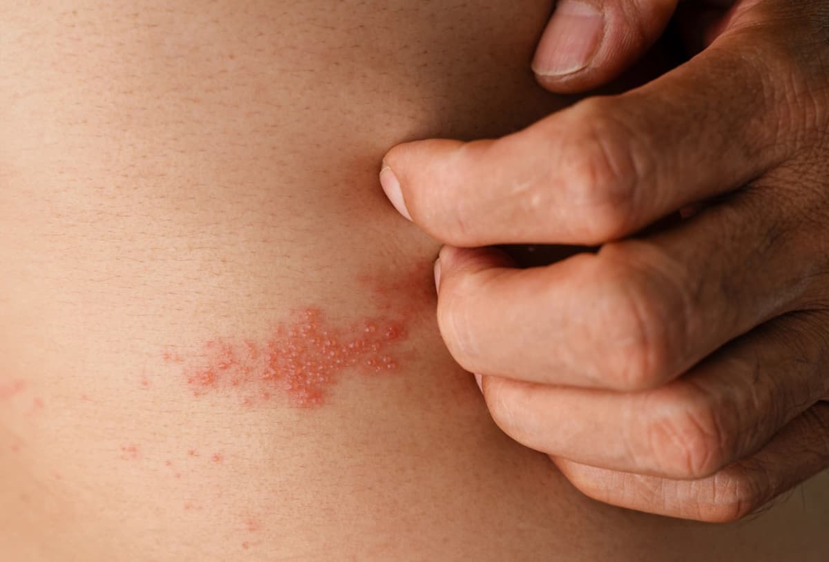 Do I have shingles? How to recognise the signs and what to do next